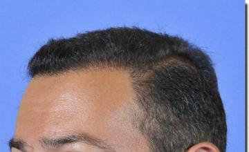 Hair restoration procedure results