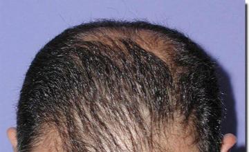 Hair restoration procedure results