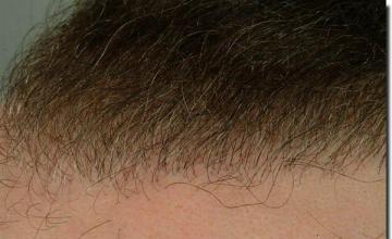 Hair restoration procedure results