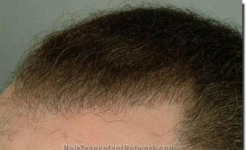 Hair restoration procedure results