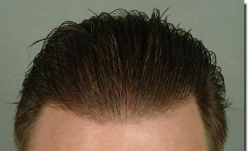 Hair restoration procedure results