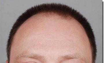 Hair restoration procedure results