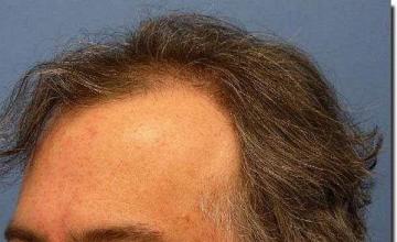 Hair restoration procedure results