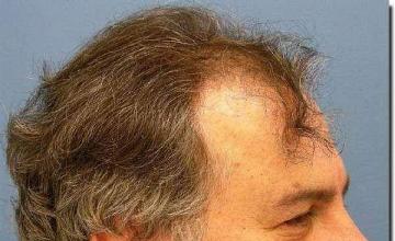 Hair restoration procedure results