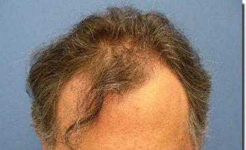 Hair restoration procedure results