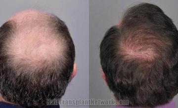 Hair restoration procedure before and after pictures