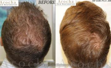 Hair restoration procedure before and after pictures