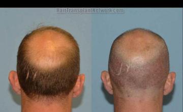 Hair restoration procedure before and after pictures