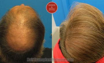 Hair restoration procedure before and after pictures