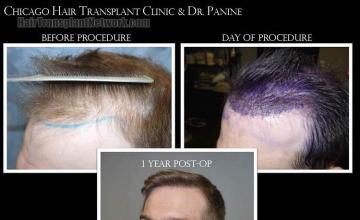 Hair transplantation surgery before and after pictures