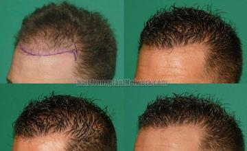 Hair transplantation surgery before and after photos