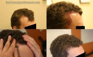 Hair transplantation surgery before and after images