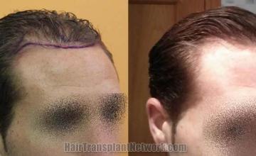 Hair transplantation surgery before and after images