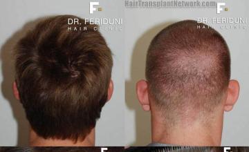 Hair transplantation surgery before and after pictures