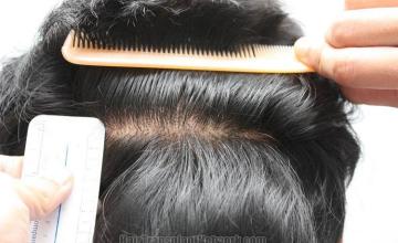 Hair restoration procedure before and after pictures