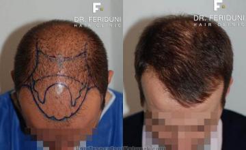 Before and after hair transplant procedure images