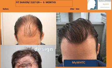 Hair transplantation surgery before and after photos