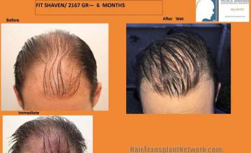 Hair restoration surgery before and after photos