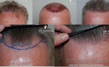 Front views showing Follicular Unit Extraction hair transplant