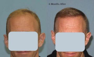 Hair restoration procedure before and after results