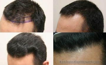 Hair replacement procedure results - left view