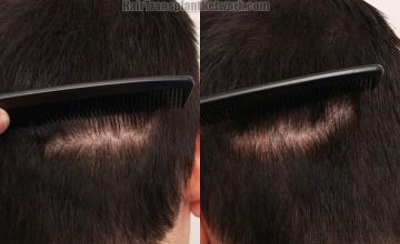 Hair restoration surgery before and after photos