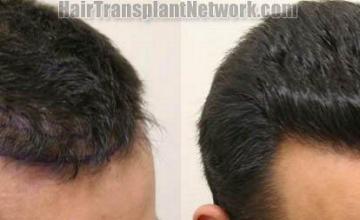 Hair transplant procedure results - Right view