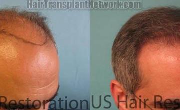 Hair restoration procedure before and after results