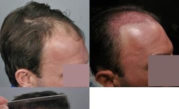 Hair restoration procedure before and after pictures