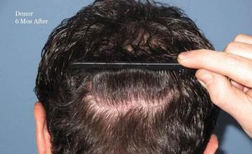 Surgical hair transplantation result photographs