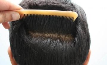 Hair restoration procedure before and after pictures