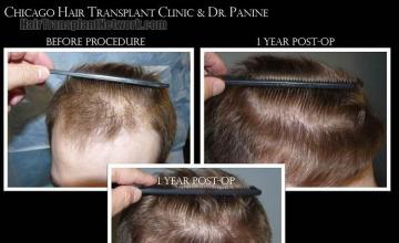 Hair transplantation surgery before and after photos