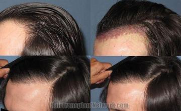 Hair transplant photos showing left view