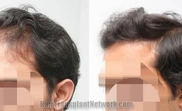 Hair transplantation surgery before and after pictures