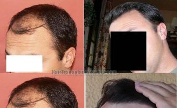 Hair transplantation surgery before and after images