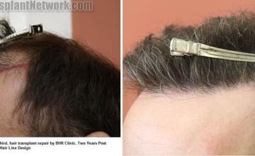 Hair transplantation surgery before and after pictures