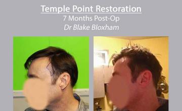 Hair restoration surgery before and after images