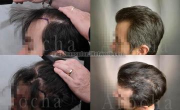  before and after photos