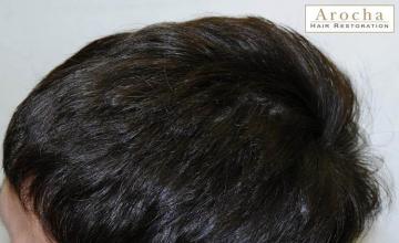 Hair transplantation surgery before and after pictures