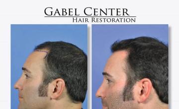 Surgical hair transplantation result photographs