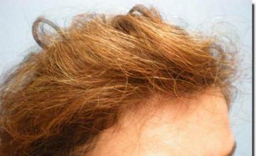 Hair restoration procedure results