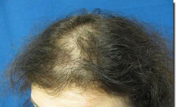 Hair restoration procedure results