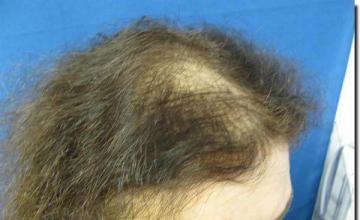 Hair restoration procedure results