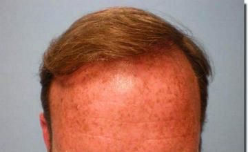 Hair restoration procedure results