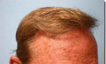 Hair restoration procedure results