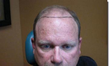 Hair restoration procedure results