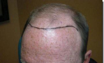 Hair restoration procedure results