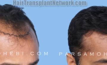 FUE  before and after photos