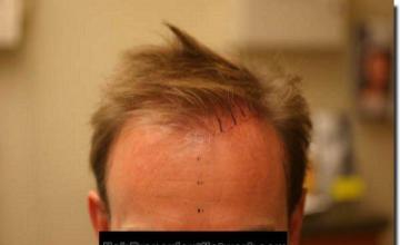 Hair restoration procedure results