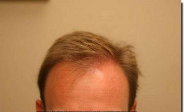 Hair restoration procedure results